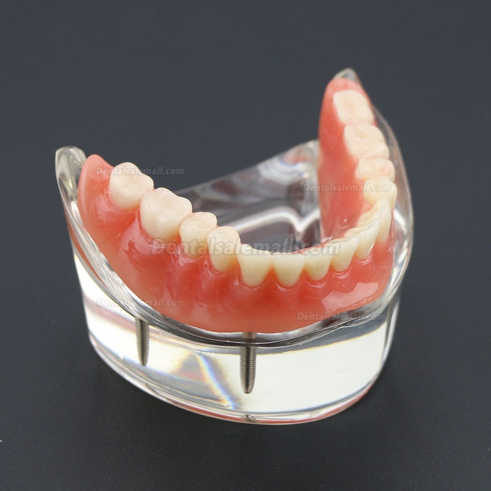 Dental Lower Teeth Demo Study Model 6002 02 Overdenture Inferior 4 Implants